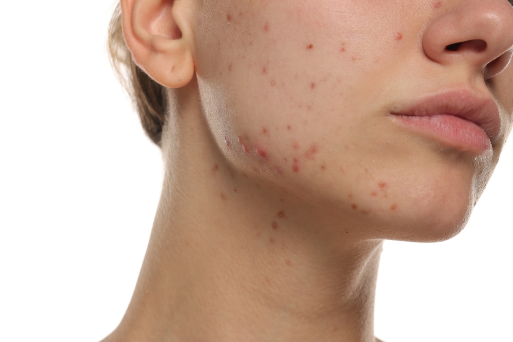 diet and acne, acne diet tips