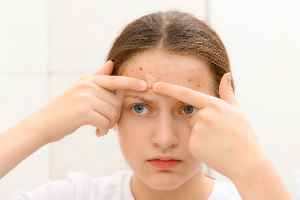 acne treatment for teens