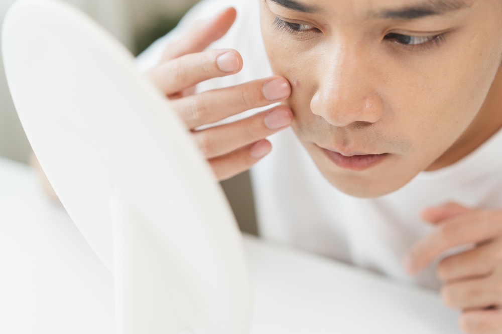 men’s acne treatments